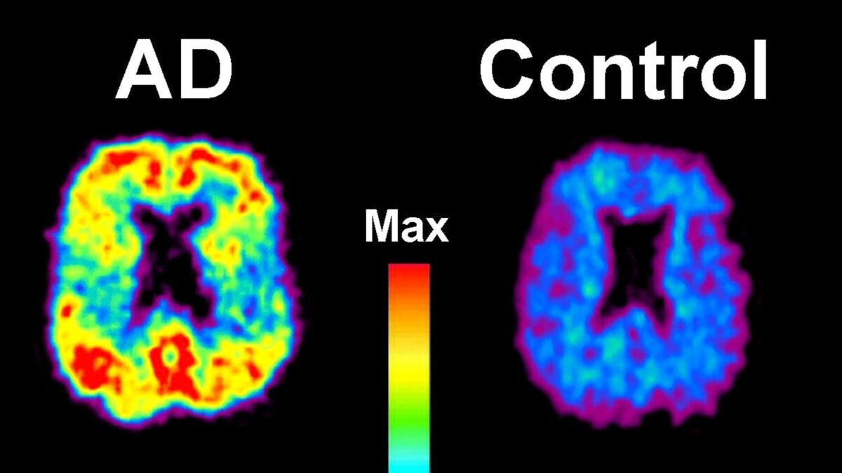 PiB-PET brain scans comparing amyloid build-up in an Alzheimer's patient's brain (left, marked AD) with a healthy control brain.