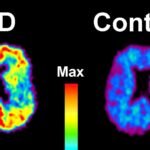 PiB-PET brain scans comparing amyloid build-up in an Alzheimer's patient's brain (left, marked AD) with a healthy control brain.