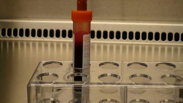 A blood sample tube in a laboratory rack — the new Alzheimer's blood tests detect p-tau217 in a routine blood draw.